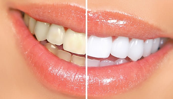 Tips For Whitening Yellow Teeth