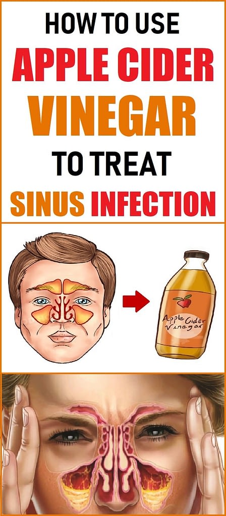 Treat Sinus Infection