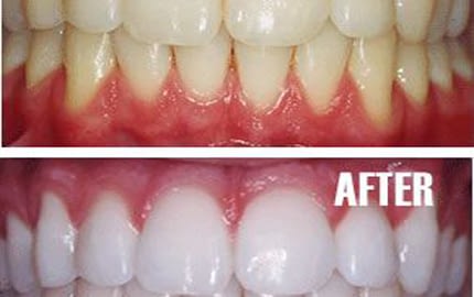 Whiten Teeth Naturally At Home