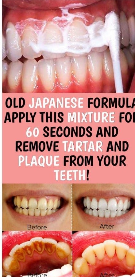 Old Japanese Formula Apply This Mixture For 60 Seconds And Remove Tartar And Plaque From Your Teeth!