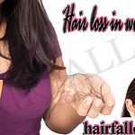 Hair loss in girls information: Causes, Signs, Remedy