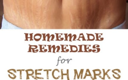 Home Remedies For Stretch Marks