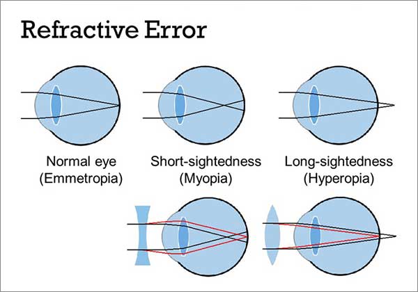  Refractive Errors Are Common Eye Diseases